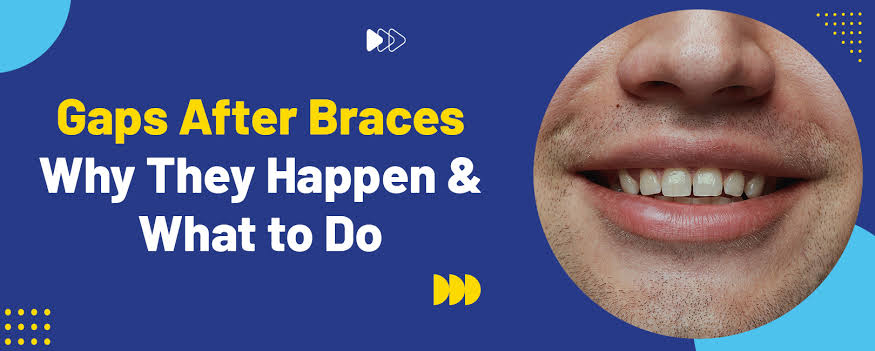 Why Are Gaps Appearing Between My Teeth After Orthodontic Treatment?
